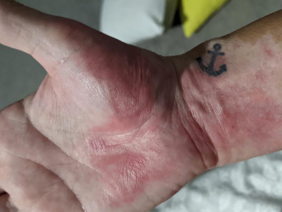 Second-degree burns Swientoniowski received on her hand. Photo Courtesy of Jennifer Swientoniowski.